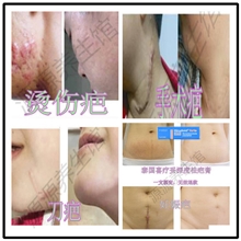 供应泰国特强型去疤膏祛疤痕祛痘印去手术伤疤烫伤7-40克假一罚十