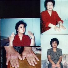 手部湿疹用臭氧处理痊愈没花一分钱家用臭氧解毒机九折供应