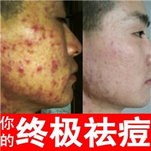 厂家高品质--消炎袪痘膏/美容院产品专供/中医推荐支持小批量