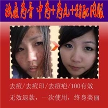 中药祛痘去痘/去痘印美白嫩肤快速去痘印全国包邮