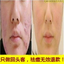 凡薇除痘消印修复液祛痘印青春痘去痘印痤疮有特效王牌产品！